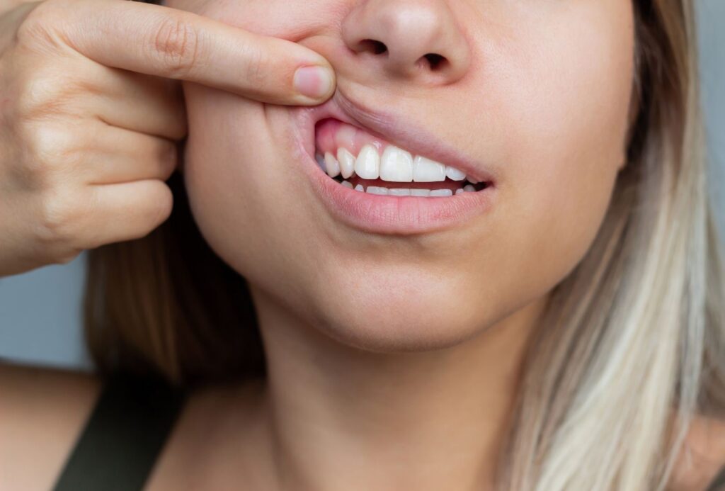 Signs and Symptoms of Gum Recession enzyme based toothpaste sensitive teeth